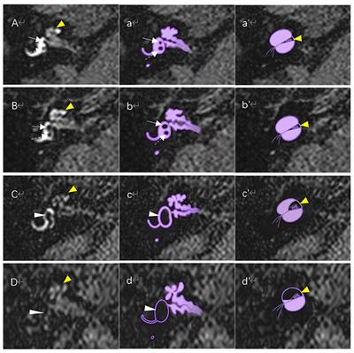 Magnetic resonance imaging of endolymphatic hydrops in Ménière's disease: A comparison of the diagnostic value of multiple scoring methods